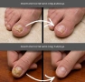 Пластири за гъбички по ноктите 21 броя, снимка 5