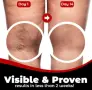 Здравен пластир за лечение на разширени вени Varicose Care Health Patch 12бр, снимка 3