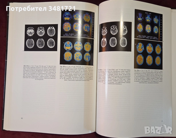 Двуезичен атлас на позитронно-емисионната томография на мозъка, снимка 13 - Здраве, медицина и спорт - 54956887
