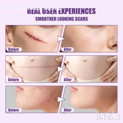 Нов Силиконов гел за белези 50 мл против стрии, акне, изгаряния и келоиди, снимка 2 - Козметика за тяло - 55395547