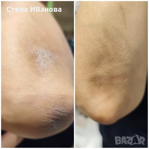 пилинг с лимон за дълбоко почистване на кожата, изравняване на тена и релефа, пигментация, белези, снимка 10 - Козметика за лице - 54924507