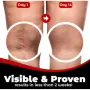 Пластири за разширени вени Varicose Care – 12 броя, снимка 2
